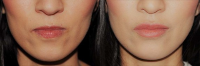 Case 7365 - Woman treated with Lip Augmentation