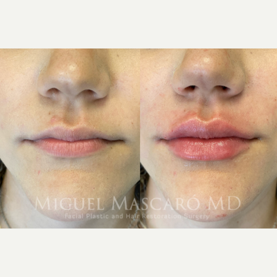 Case 7366 - 18-24 year old woman treated with Lip Augmentation