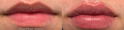 Case 7367 - Man treated with Lip Augmentation