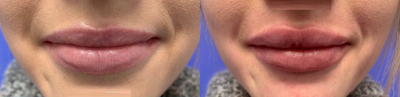 Case 7368 - Woman treated with Lip Augmentation