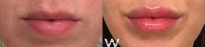 Case 7369 - Woman treated with Lip Augmentation