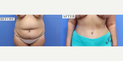 Case 737 - Woman treated with Tummy Tuck