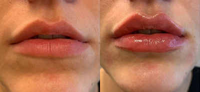 Case 7370 - Woman treated with Lip Augmentation