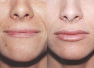 Case 7371 - Woman treated with Lip Augmentation