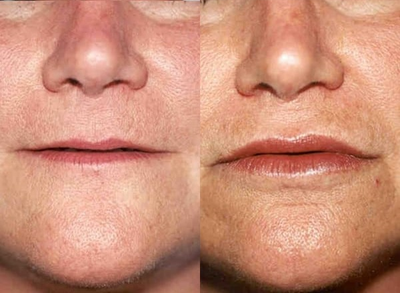 Case 7372 - Woman treated with Lip Augmentation