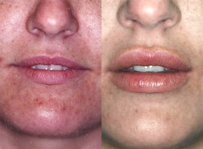 Case 7373 - Woman treated with Lip Augmentation