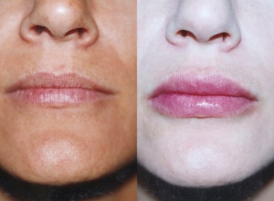 Case 7374 - Woman treated with Lip Augmentation