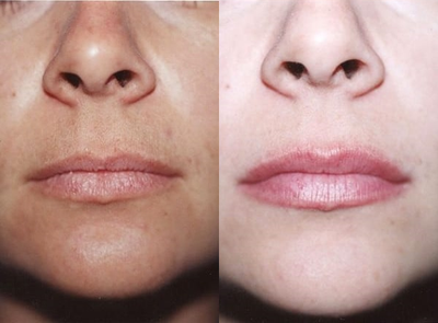 Case 7375 - Woman treated with Lip Augmentation