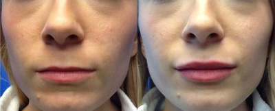 Case 7377 - 25-34 year old woman treated with Lip Augmentation