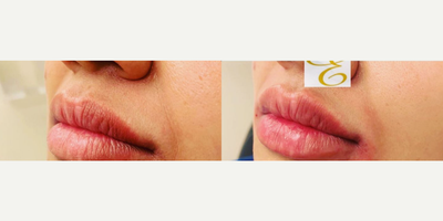 Case 7378 - Woman treated with Lip Fillers