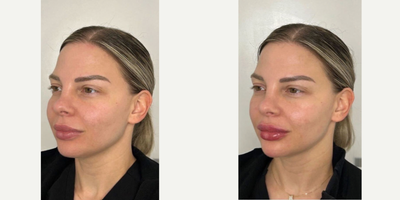Case 7379 - 25-34 year old woman treated with Chin Filler, Lip Fillers, Dermal Fillers