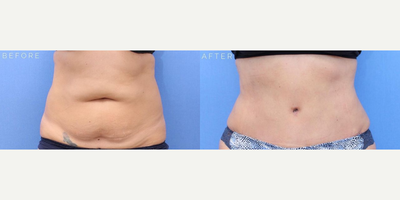 Case 738 - Woman treated with Tummy Tuck