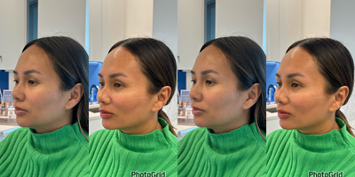 Case 7380 - 35-44 year old woman treated with Dermal Fillers, Cheek Augmentation, Lip Fillers