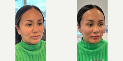 Case 7381 - 35-44 year old woman treated with Dermal Fillers, Cheek Augmentation, Lip Fillers