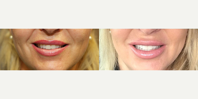 Case 7382 - Woman treated with Lip Augmentation
