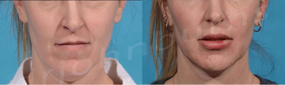 Case 7384 - Treated with Lip Augmentation