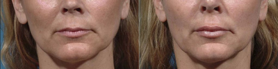 Case 7385 - Treated with Lip Augmentation