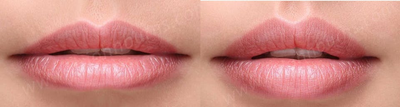 Case 7386 - Treated with Lip Augmentation