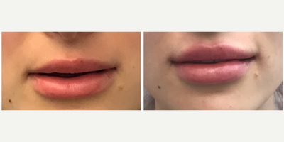Case 7387 - 25-34 year old woman treated with Lip Augmentation