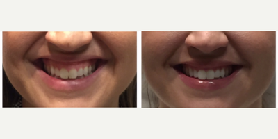Case 7388 - 25-34 year old woman treated with Lip Augmentation