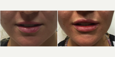 Case 7389 - 25-34 year old woman treated with Lip Augmentation