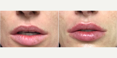 Case 7390 - 35-44 year old woman treated with Lip Augmentation