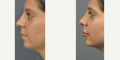 Case 7391 - Juvederm, Lip Fillers, Lip Lift, Dermal Fillers