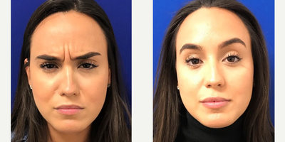 Case 7392 - 25-34 year old woman treated with Lip Augmentation