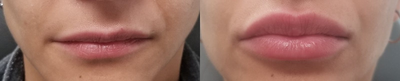 Case 7396 - Lip Augmentation