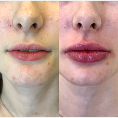 Case 7398 - 18-24 year old woman treated with Lip Augmentation