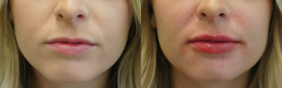 Case 7399 - 18-24 year old woman treated with Lip Augmentation