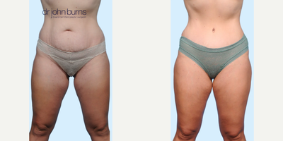 Case 74 - Woman treated with Tummy Tuck