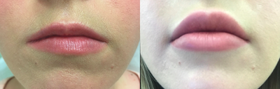 Case 7400 - 27 year old post lip augmentation 