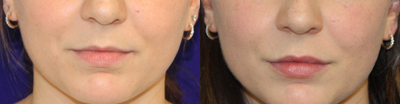 Case 7401 - 18-24 year old woman treated with Lip Augmentation