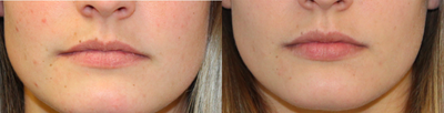 Case 7402 - 18-24 year old woman treated with Lip Augmentation