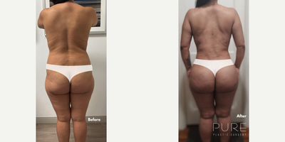 Case: 7403 - before and after photo of Woman treated with Brazilian Butt Lift by S. Alexander Earle, MD, FACS