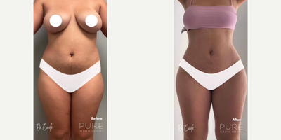 Case: 7404 - before and after photo of Woman treated with Brazilian Butt Lift by S. Alexander Earle, MD, FACS