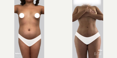 Case: 7406 - before and after photo of Woman treated with Brazilian Butt Lift by S. Alexander Earle, MD, FACS