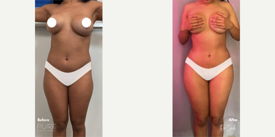 Case: 7407 - before and after photo of Woman treated with Brazilian Butt Lift by S. Alexander Earle, MD, FACS