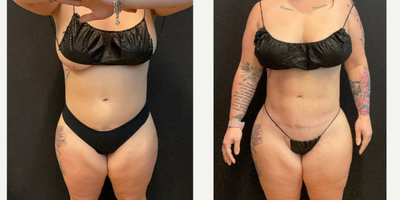 Case: 7408 - before and after photo of 35-44 year old woman treated with Brazilian Butt Lift, Abdominal Etching by Johnny Franco, MD, FACS