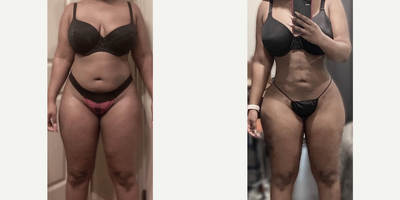 Case: 7409 - before and after photo of Woman treated with Brazilian Butt Lift by S. Alexander Earle, MD, FACS