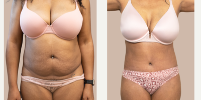 Case 741 - 35-44 year old woman treated with Tummy Tuck