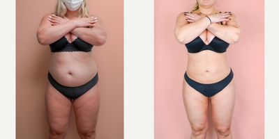 Case 7421 - 25-34 year old woman treated with Brazilian Butt Lift, Liposuction