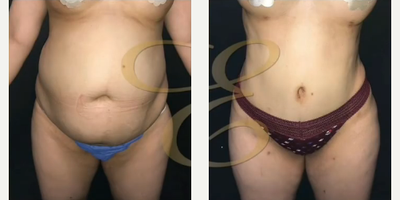 Case 7423 - Woman treated with Brazilian Butt Lift, Liposuction
