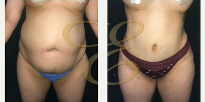 Case 7424 - Woman treated with Liposuction, Brazilian Butt Lift