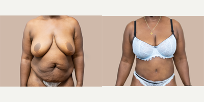 Case 743 - 45-54 year old woman treated with Tummy Tuck