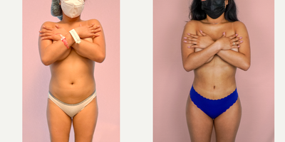 Case 7431 - 18-24 year old woman treated with Brazilian Butt Lift, Liposuction