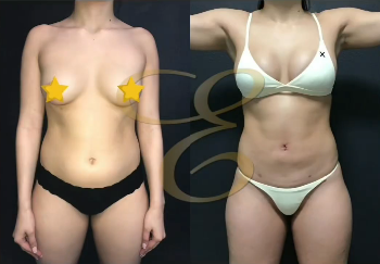Case 7433 - Woman treated with Liposuction, Brazilian Butt Lift