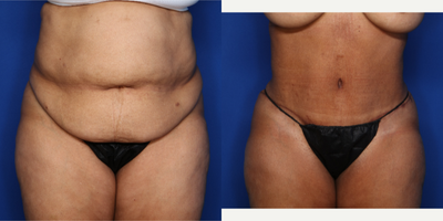 Case 744 - 45-54 year old woman treated with Tummy Tuck