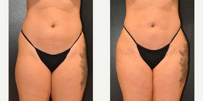 Case 7441 - 22 year old woman treated with Brazilian Butt Lift